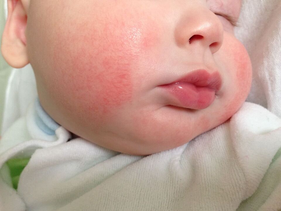 Un segno di vermi in un bambino è l'orticaria allergica